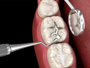 True White Dental Types of Dental Fillings 1 True White Dental Types of Dental Fillings