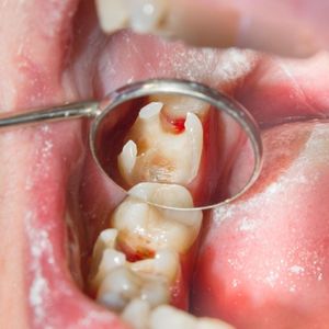 True White dental Decay Removal