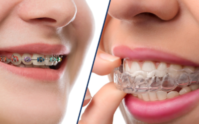 What Causes Tooth Sensitivity and How to Reduce It – A Detailed Guide by True White Dental, Kondapur, Hyderabad