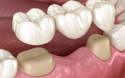 Crowns or Veneers: Which One Do You Actually Need?