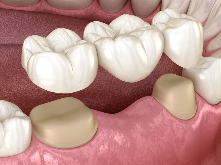 Crowns or Veneers: Which One Do You Actually Need?