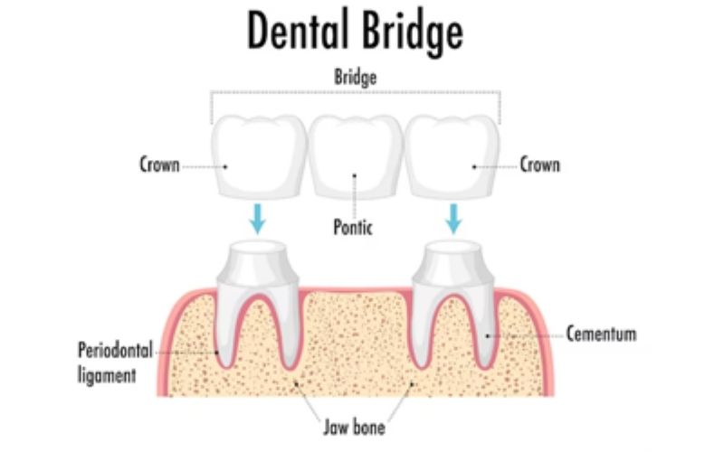 TrueWhiteDentalCrownsBridges truewhite True White Dental Crowns Bridges