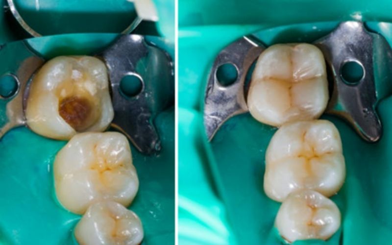 TrueWhiteDentalDentalFillings truewhite True White Dental Dental Fillings