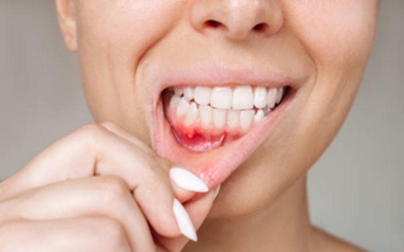 TrueWhiteDentalGumDiseaseManagement truewhite True White Dental Gum Disease Management