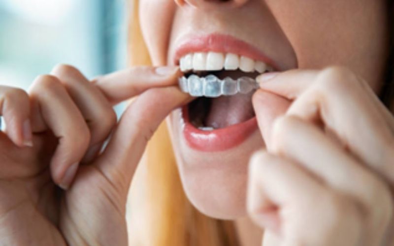 TrueWhiteDentalInvisalign truewhite True White Dental Invisalign