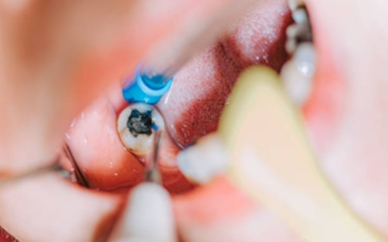 TrueWhiteDentalRootCanalTreatment truewhite