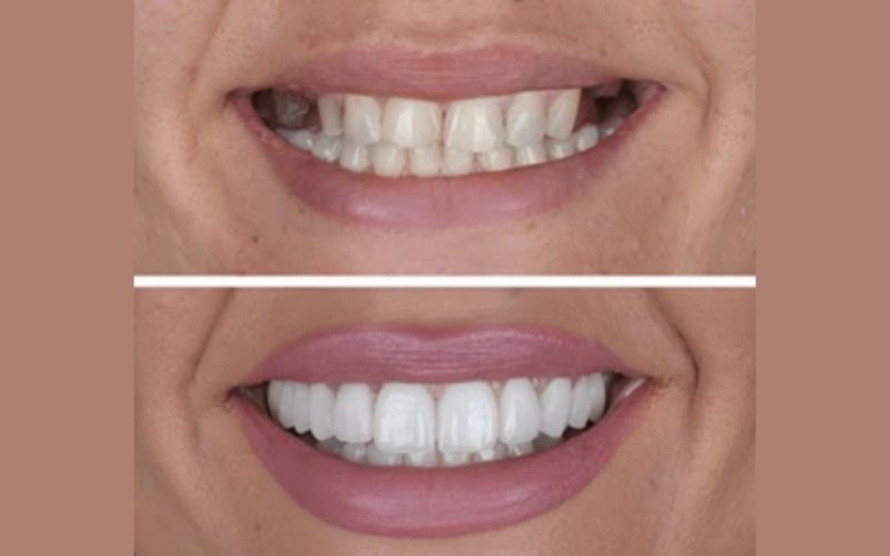 TrueWhiteDentalSmileDesigning truewhite True White Dental Smile Designing