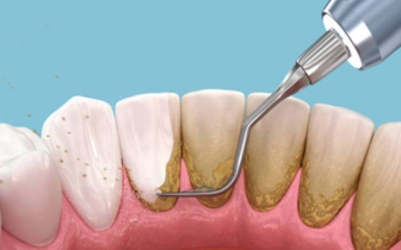TrueWhiteDentalTeethCleaning truewhite True White Dental Teeth Cleaning