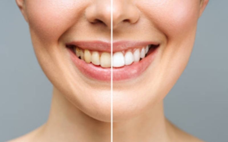 TrueWhiteDentalTeethWhitening truewhite True White Dental Teeth Whitening