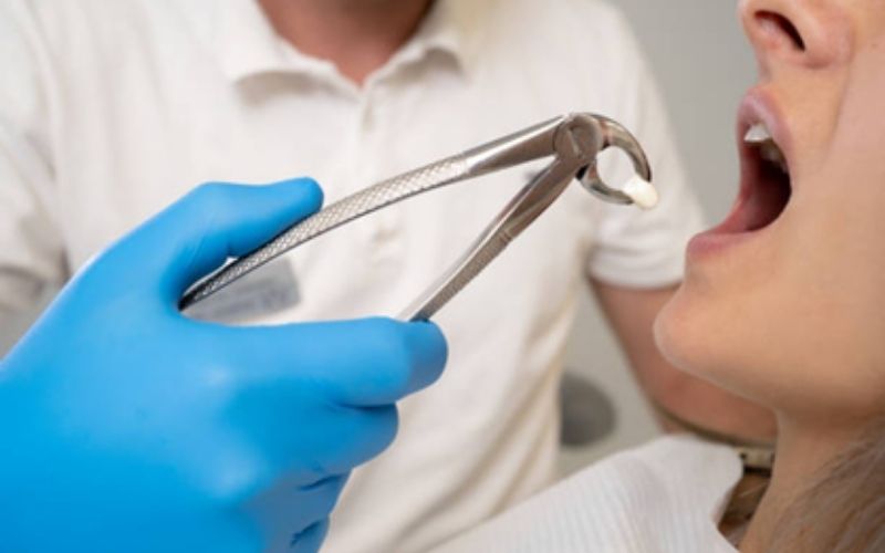 TrueWhiteDentalWisdomToothExtraction truewhite True White Dental Wisdom Tooth Extraction