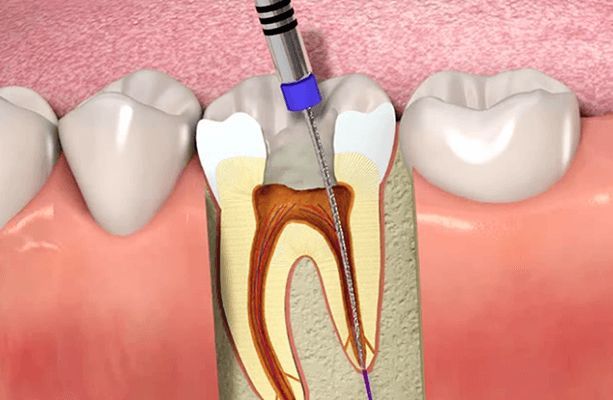 Is Root Canal Treatment Really Painful?