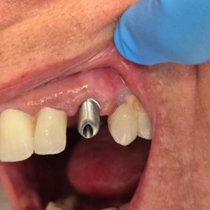 Close up of an upper jaw with an exposed dental implant abutment in the gum beside adjacent teeth with a gloved hand nearby
