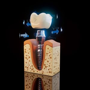 Cross section view of a dental implant titanium screw in the jawbone with an abutment and a crown showing chewing forces with arrows around it