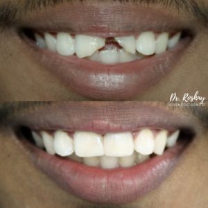 Before and after close up of a smile top image shows a chipped front tooth gap bottom image shows straight whiter teeth after cosmetic treatment