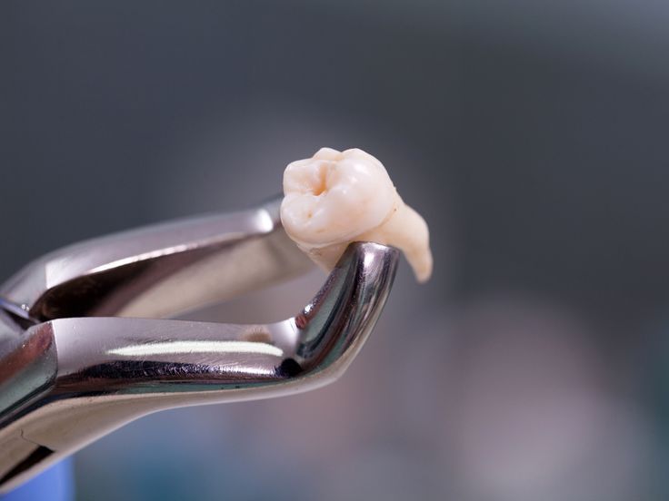 Wisdom Tooth Removal in Kondapur: Symptoms, Procedure and Recovery