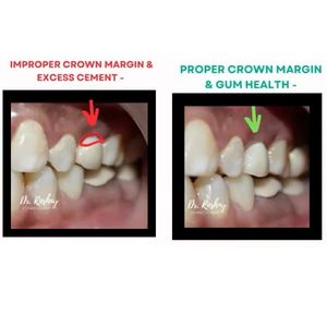 Left improper crown margin with excess cement red arrow right proper margin and healthy gums green arrow