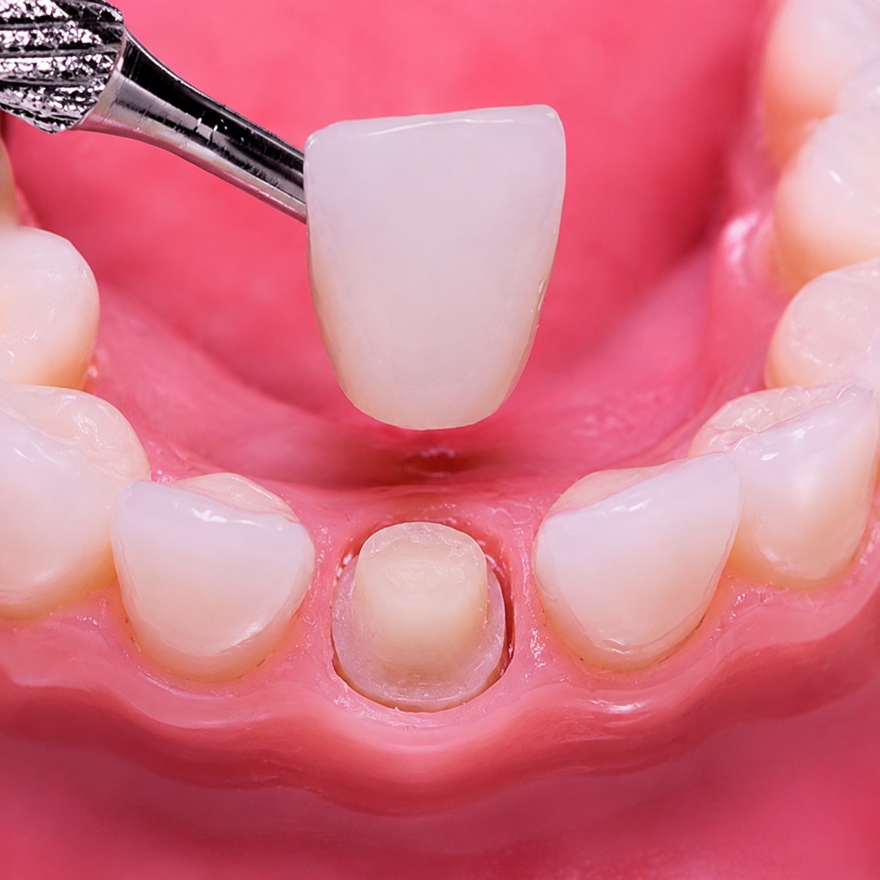 Close up of a dental model with a ceramic crown being seated onto a prepared front tooth surrounded by pink gum tissue