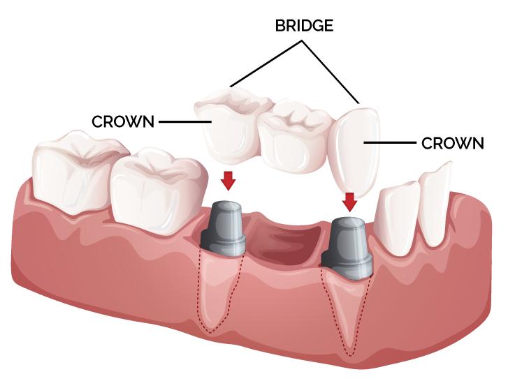 Dental implant bridge two implants in the lower jaw with crowns supporting a bridge that replaces missing teeth between natural teeth