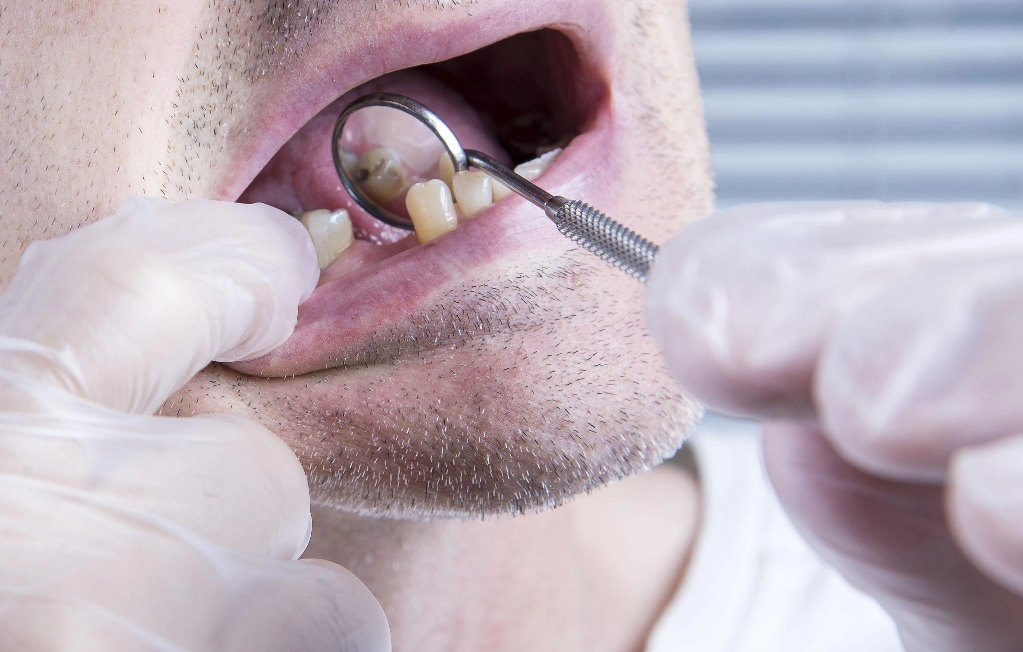 EvaluationofMissingTeethGumSupport truewhite Close up of a dentist using a mirror and dental probe to examine a patients lower teeth
