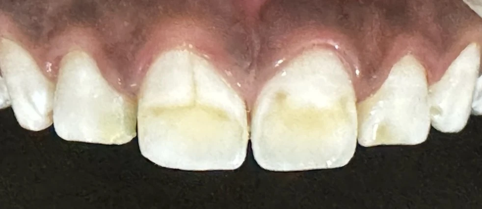 Close up of the upper front teeth showing yellow enamel stains on the two central incisors and surrounding gums